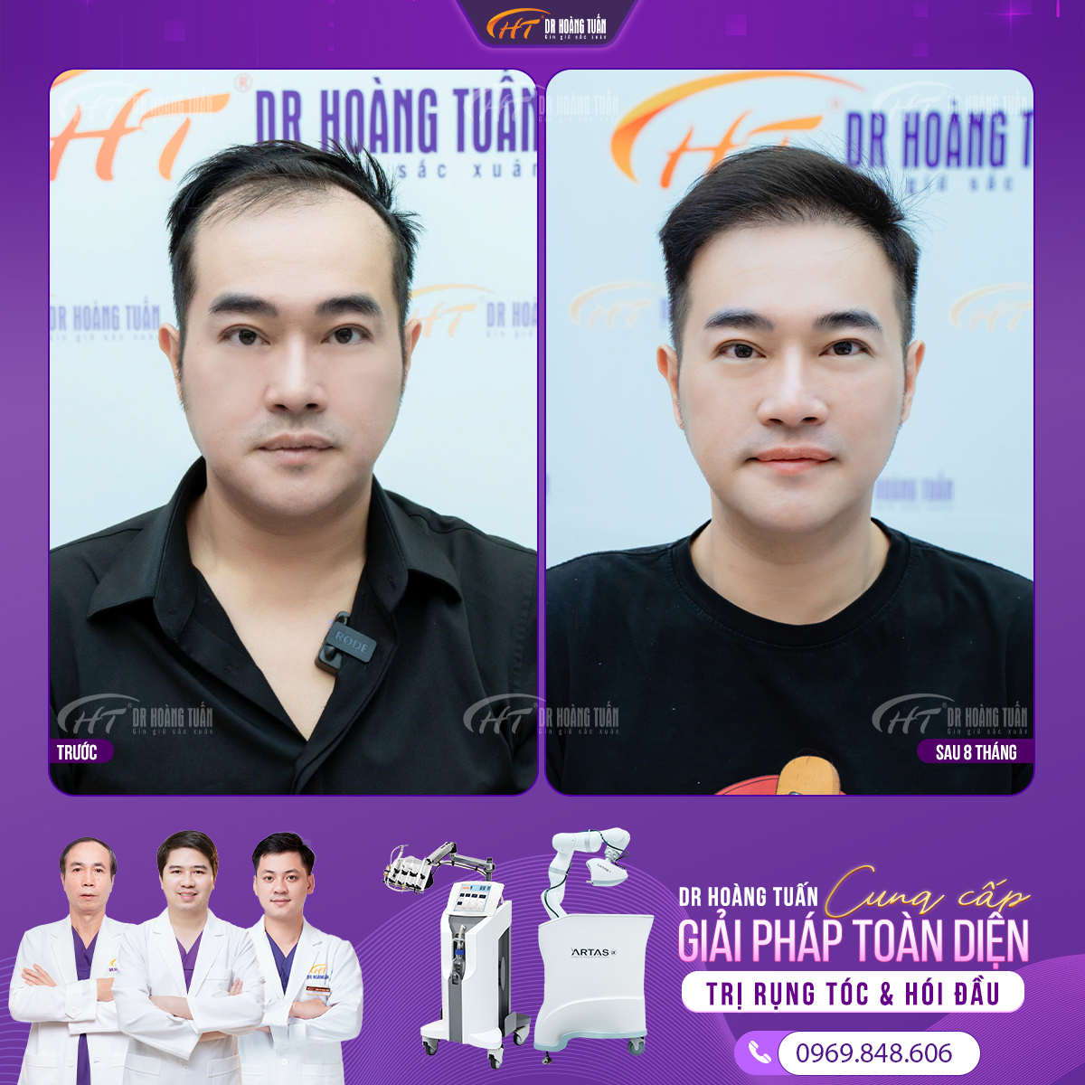 Hiệu quả khi cấy tóc nam