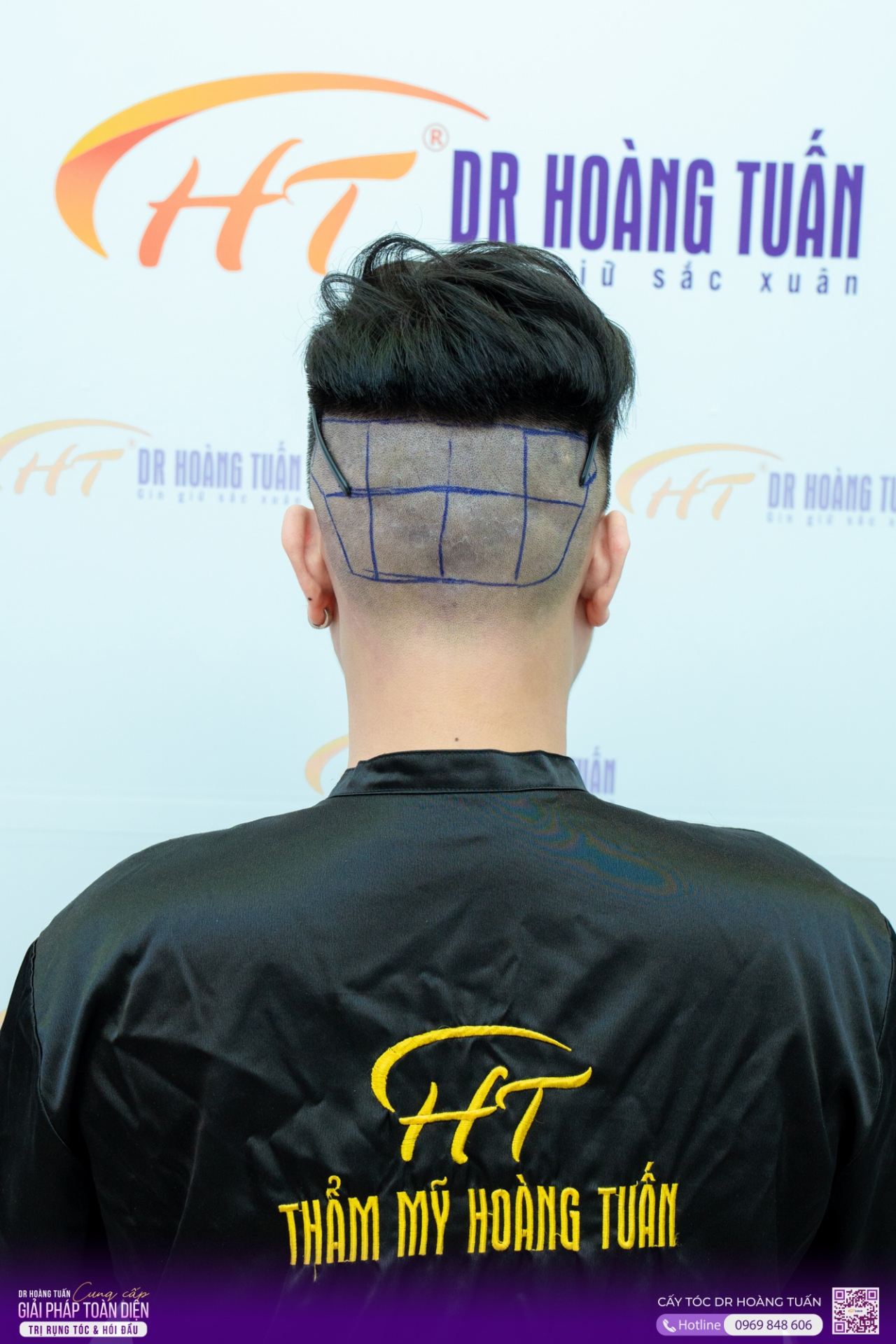 cấy tóc trị hói có hiệu quả không