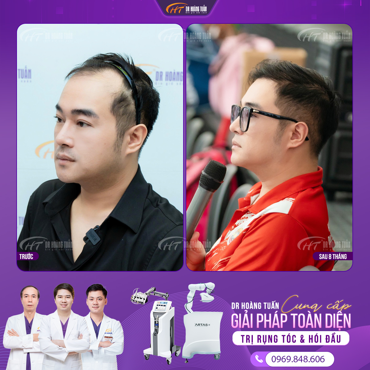 hói đầu di truyền như thế nào