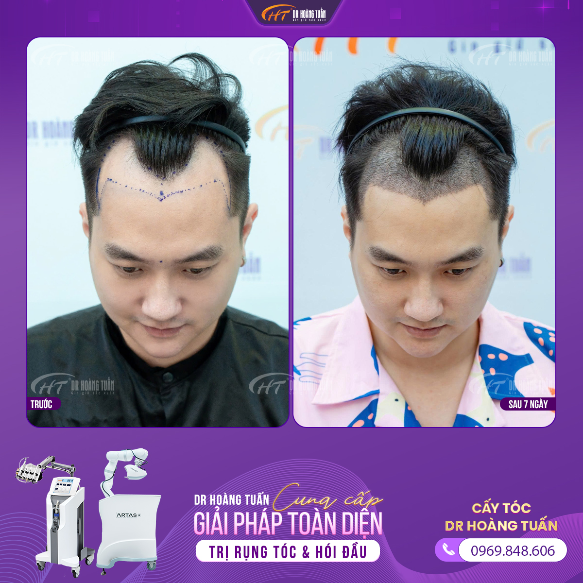 cấy tóc có đắt không