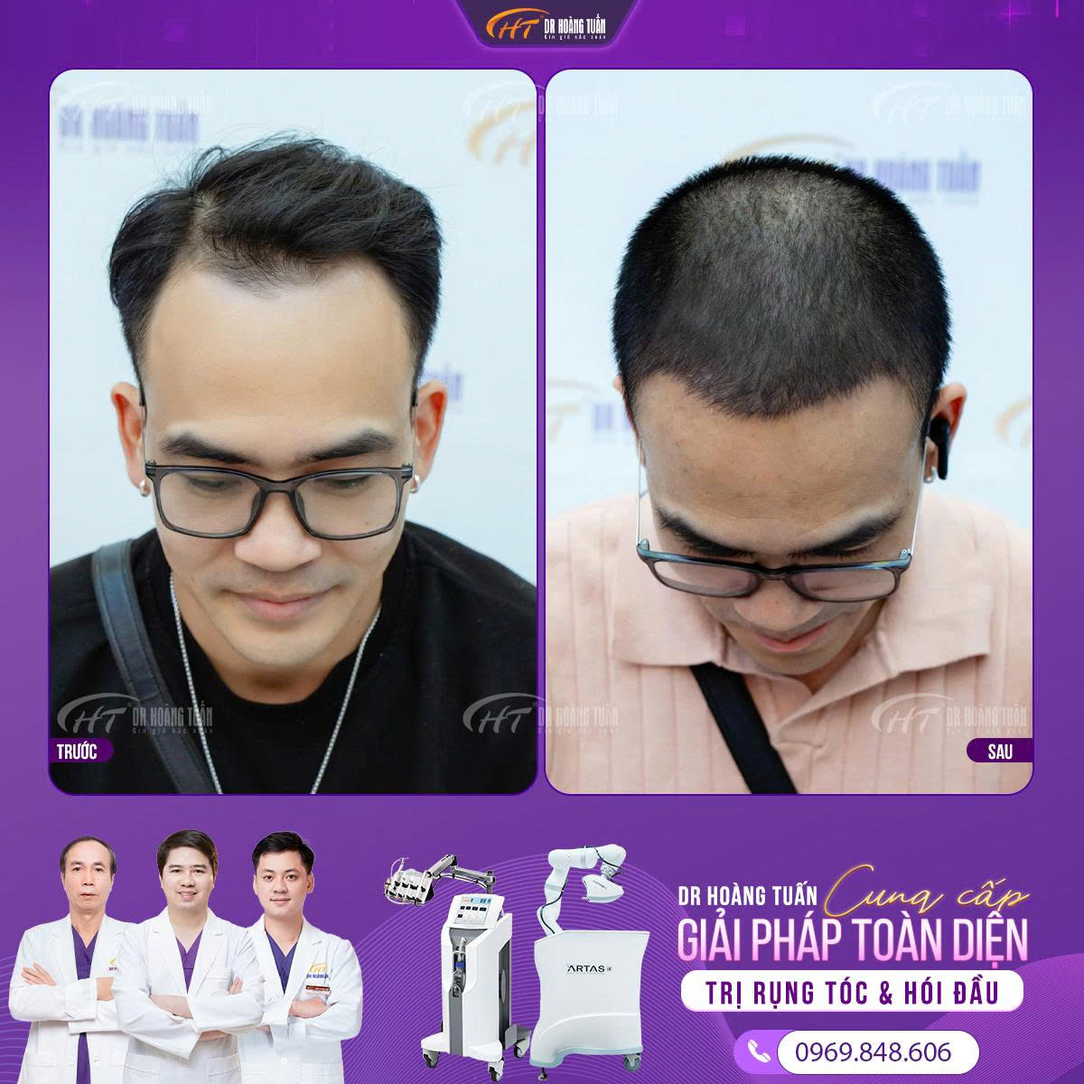 Cấy tóc ở trán