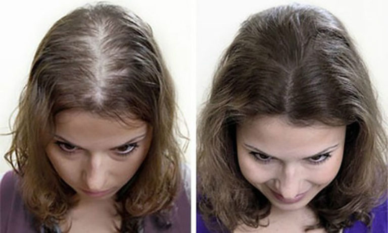 cách trị hói đầu bằng vỏ bưởi