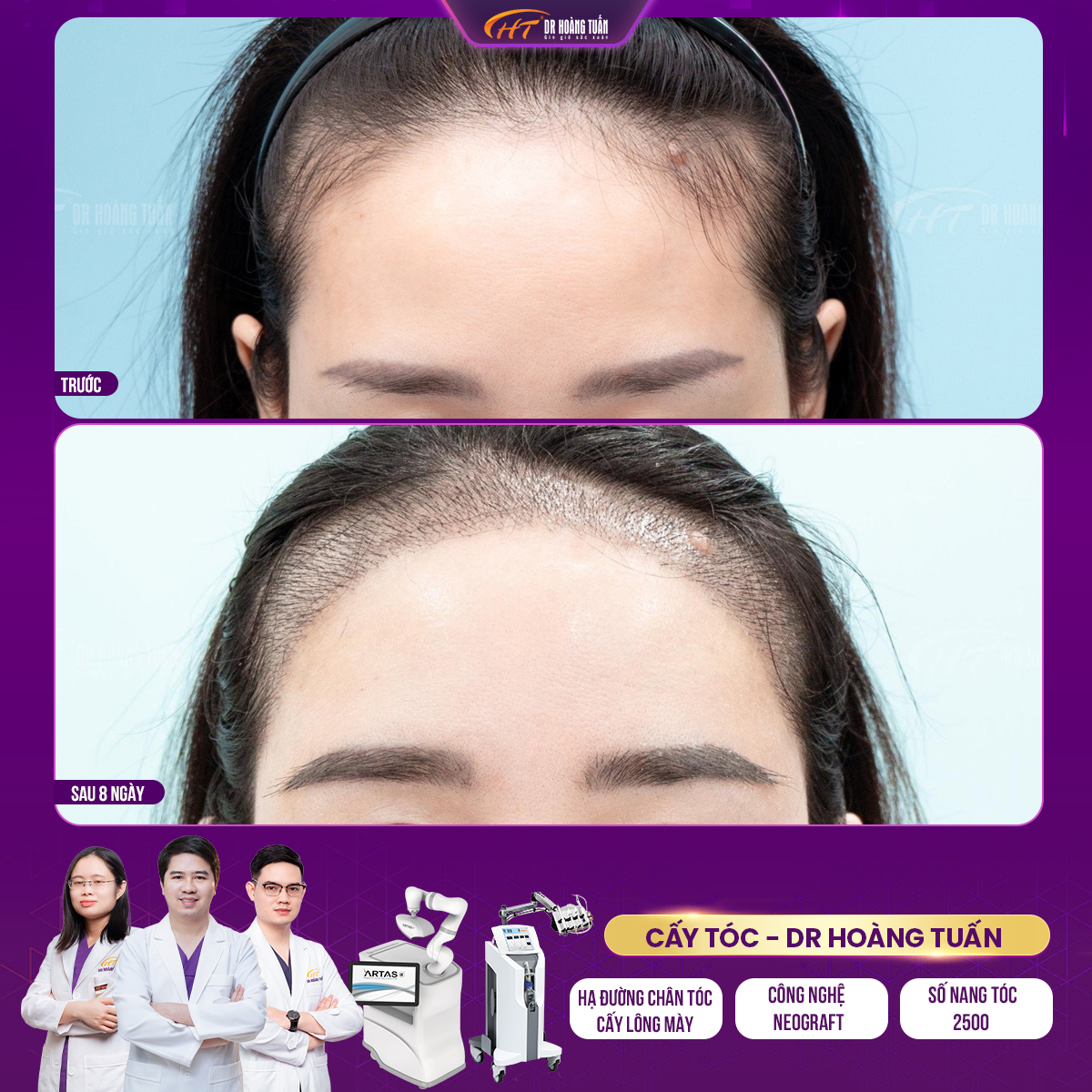 Cải thiện đường chân tóc