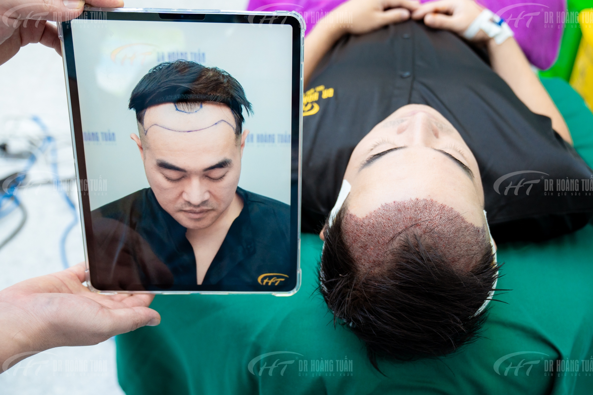 cấy tóc tự thân