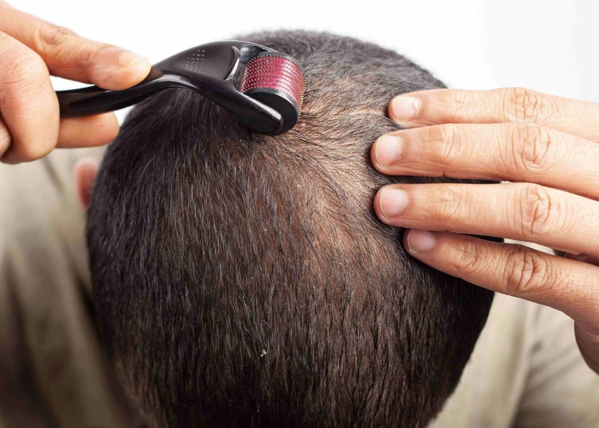 Phương pháp lăn kim trị hói đầu