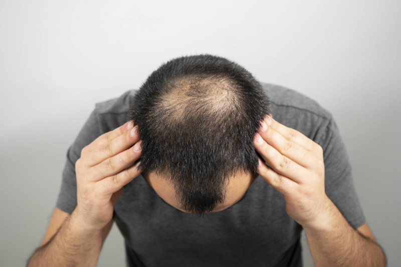 Hói đầu di truyền có chữa được không