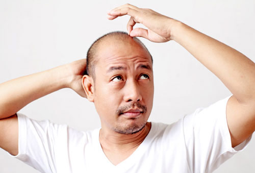 Ai nên sử dụng phương pháp lăn kim trị hói đầu