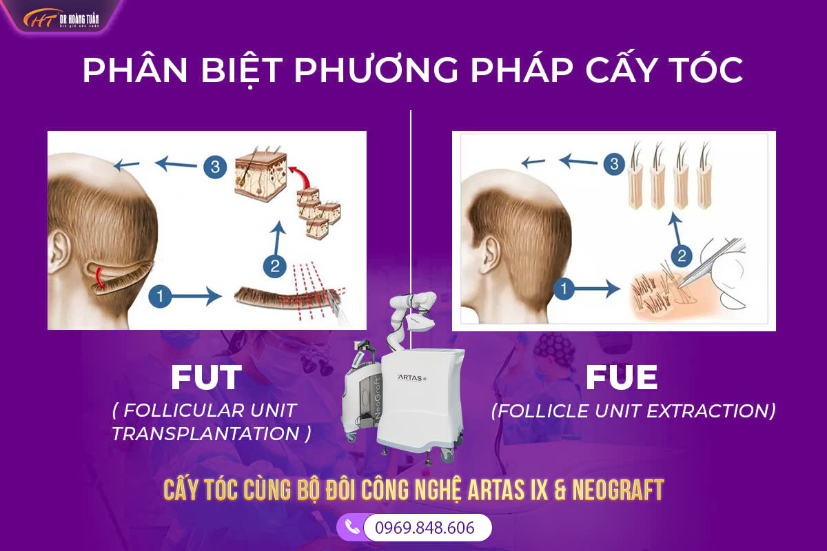 Chuẩn Bị Trước Khi Quyết Định Cấy Tóc