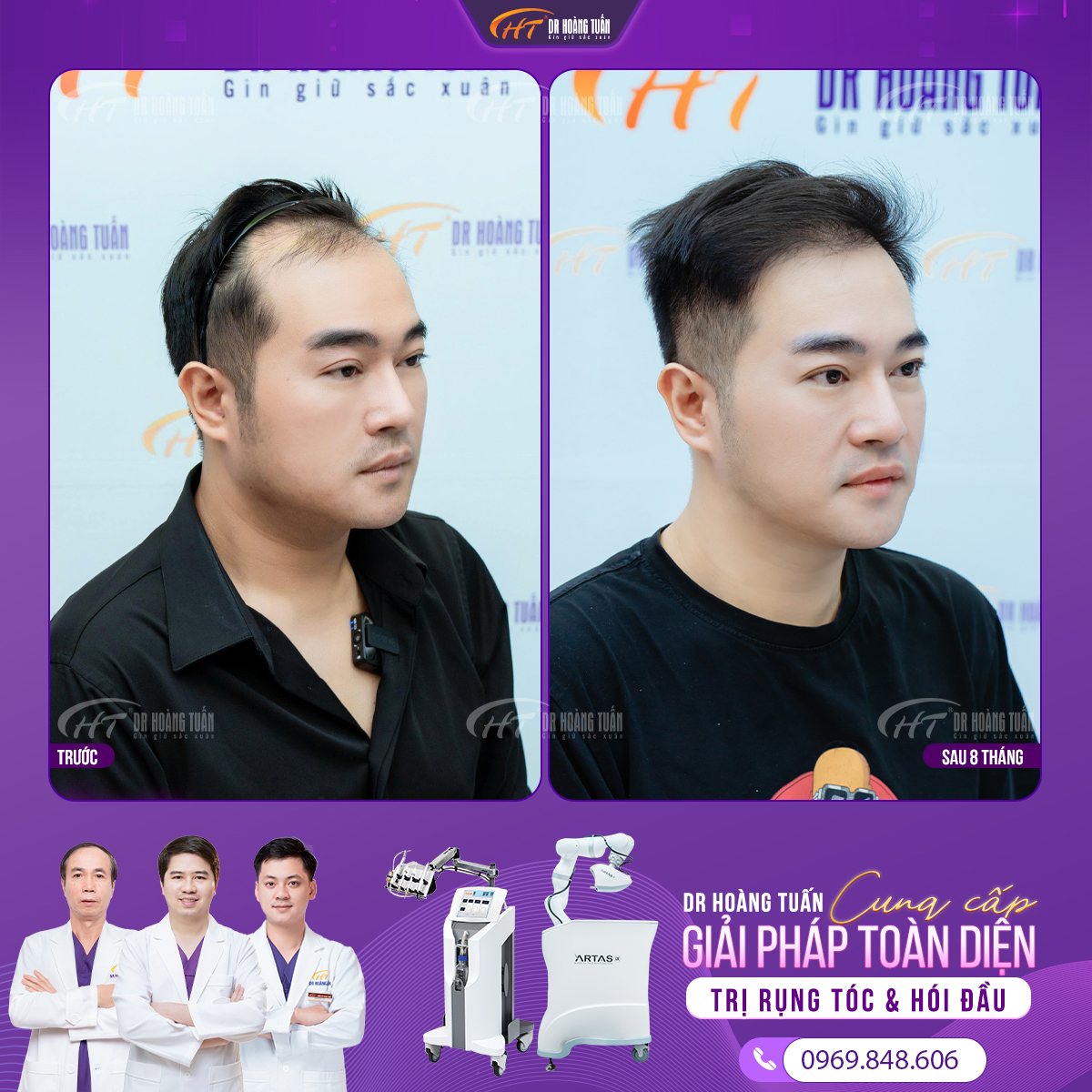 Kết quả cấy tóc trị hói nam