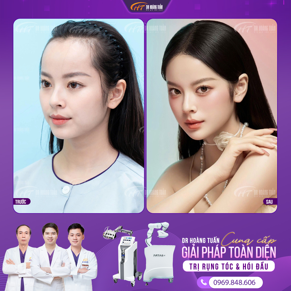 Kết quả sau cấy tóc trị hói nữ