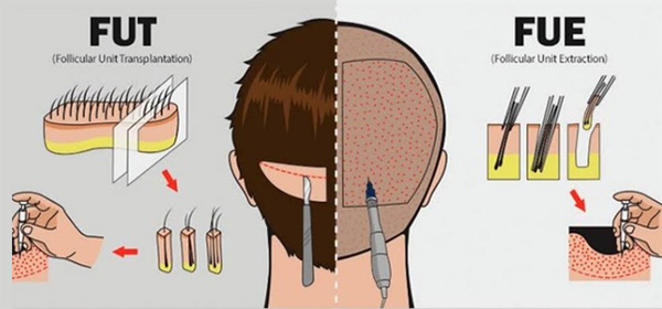 Cấy tóc FUE và FUT