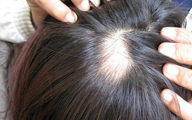 Nguyên nhân hói đầu ở nữ