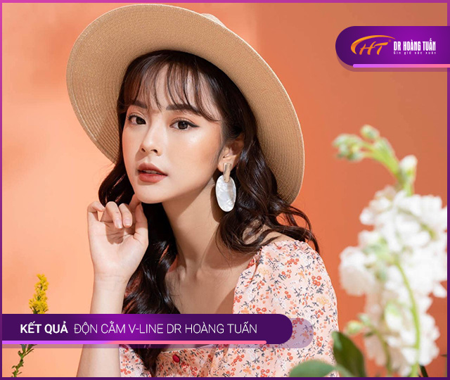 Hình ảnh kết quả độn cằm Vline tại Dr Hoàng Tuấn