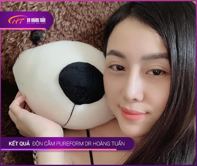 Hình ảnh kết quả độn cằm Vline tại Dr Hoàng Tuấn