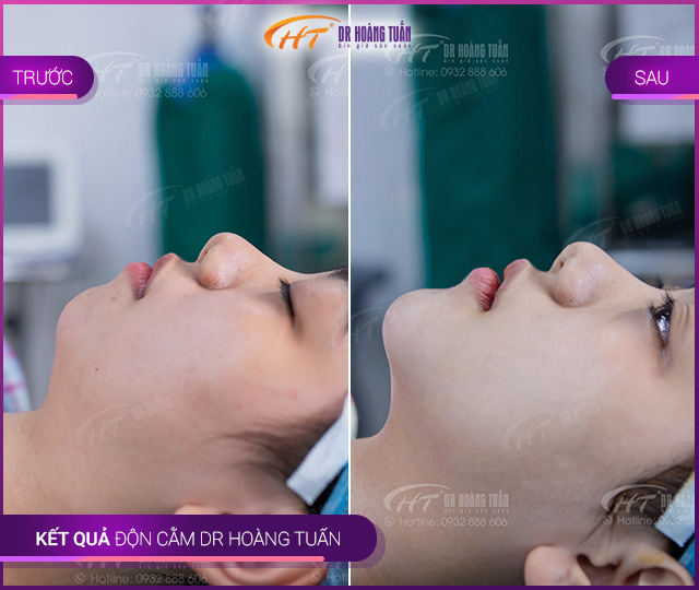 Hình ảnh kết quả độn cằm Vline tại Dr Hoàng Tuấn