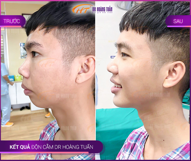 Hình ảnh kết quả độn cằm Vline tại Dr Hoàng Tuấn