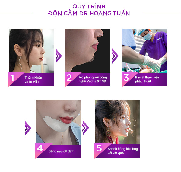 Quy trình thực hiện độn cằm vline