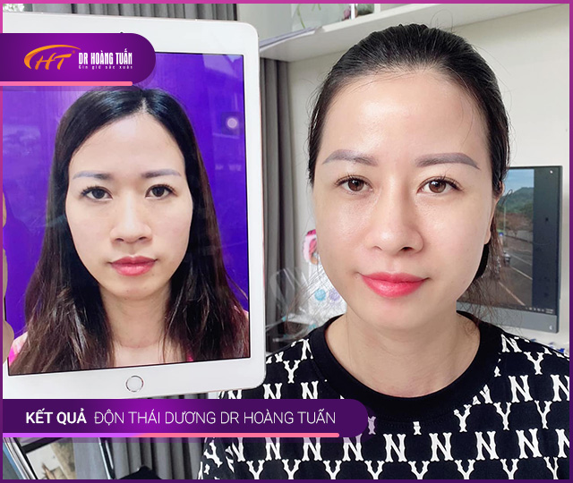 Hình ảnh kết quả độn thái dương tại Dr Hoàng Tuấn