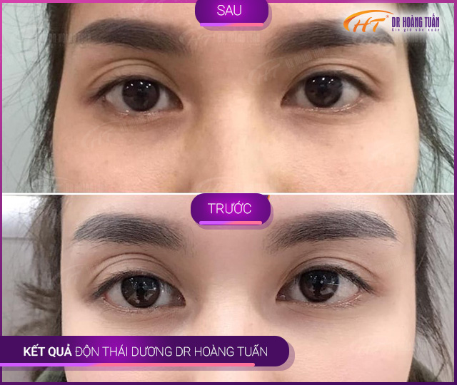 Hình ảnh kết quả độn thái dương tại Dr Hoàng Tuấn