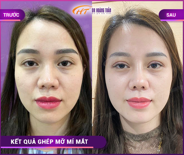 Hình ảnh kết quả ghép mỡ mí mắt