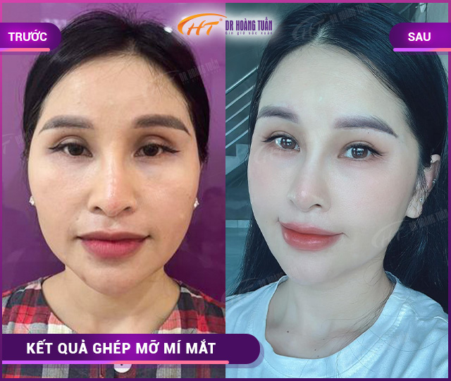 Hình ảnh kết quả ghép mỡ mí mắt