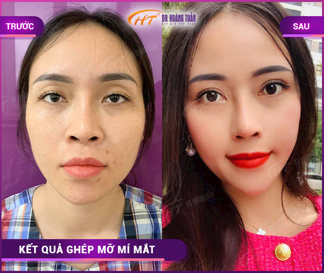 Hình ảnh kết quả ghép mỡ mí mắt