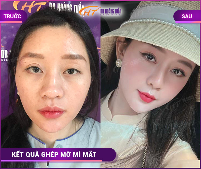 Hình ảnh kết quả ghép mỡ mí mắt