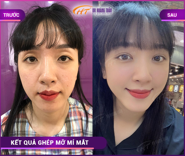 Hình ảnh kết quả ghép mỡ mí mắt