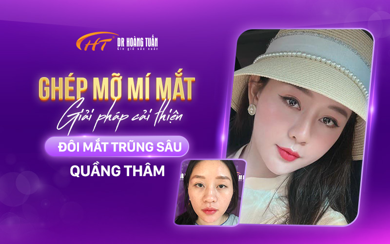 Ghép mỡ mí mắt tại Dr Hoàng Tuấn