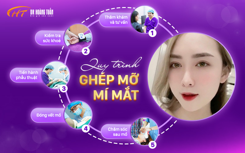 Quy trình ghép mỡ mí mắt 