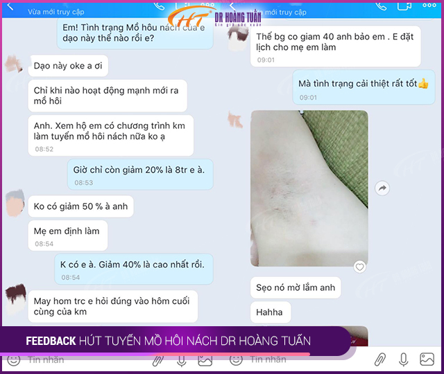 feedback của khách hàng khi hút tuyến mồ hôi tại Dr Hoàng Tuấn