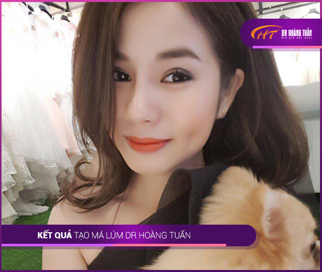 Hình ảnh kết quả tạo má lúm đồng tiền