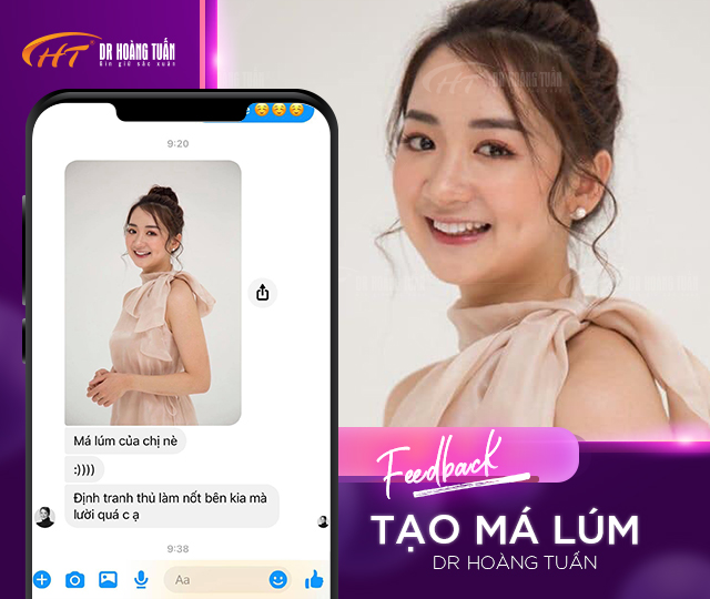 Feedback của khách hàng về tạo má lúm đồng tiền tại Dr Hoàng Tuấn