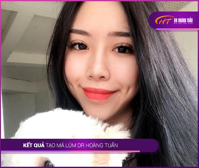 Hình ảnh kết quả tạo má lúm đồng tiền