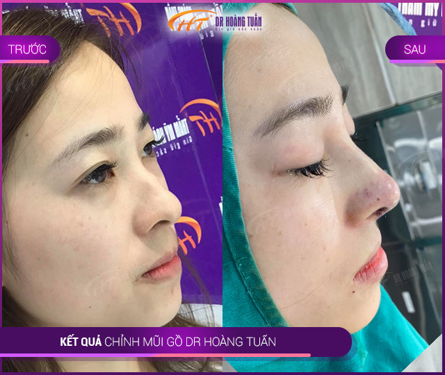 Hình ảnh kết quả mài gồ mũi tại Dr Hoàng Tuấn