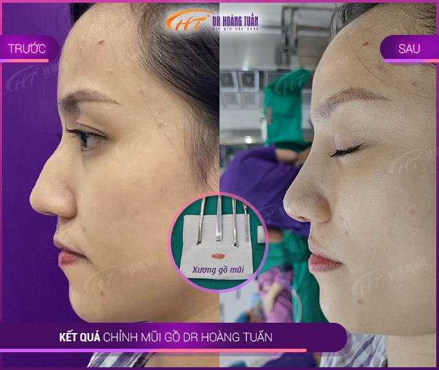 Hình ảnh kết quả mài gồ mũi tại Dr Hoàng tuấn