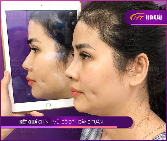 Hình ảnh kết quả mài gồ mũi tại Dr Hoàng Tuấn