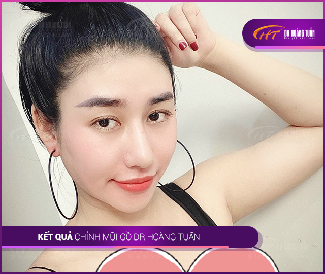 Hình ảnh kết quả mài gồ mũi tại Dr Hoàng Tuấn