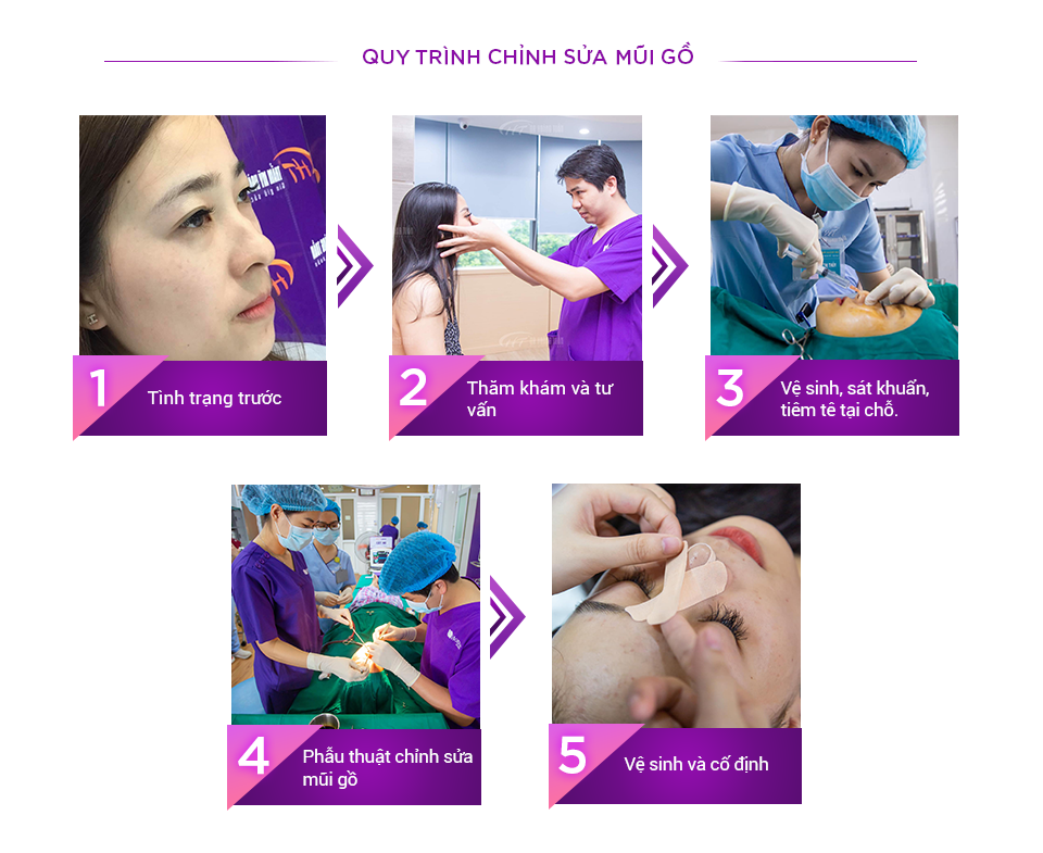 Quy trình mài gồ mũi