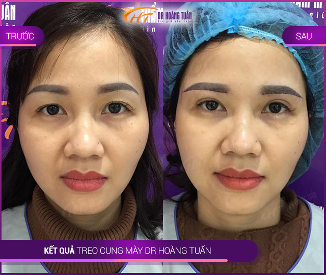nâng (treo) cung mày