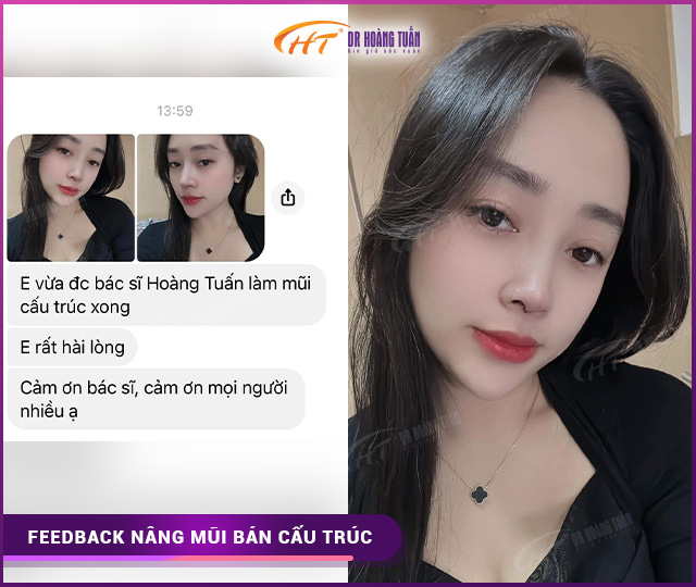 Feedback của khách hàng khi nâng mũi bán cấu trúc tại Dr Hoàng Tuấn