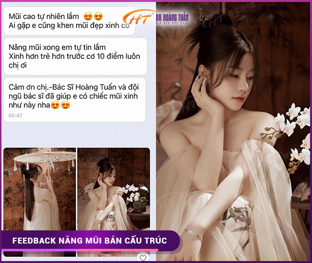 Feedback của khách hàng khi nâng mũi bán cấu trúc tại Dr Hoàng Tuấn