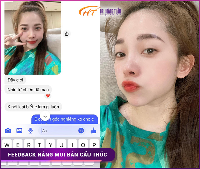 Feedback của khách hàng khi nâng mũi bán cấu trúc tại Dr Hoàng Tuấn