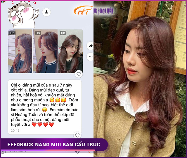 Feedback của khách hàng khi nâng mũi bán cấu trúc tại Dr Hoàng Tuấn