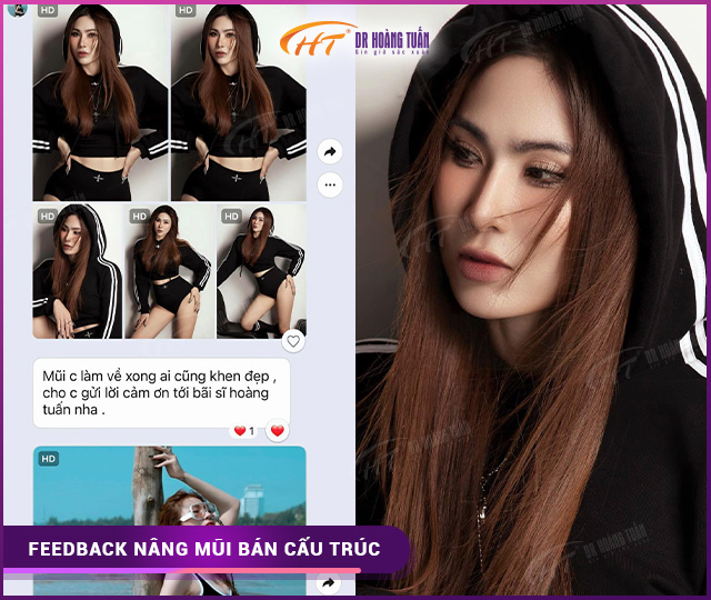 Feedback của khách hàng khi nâng mũi bán cấu trúc tại Dr Hoàng Tuấn