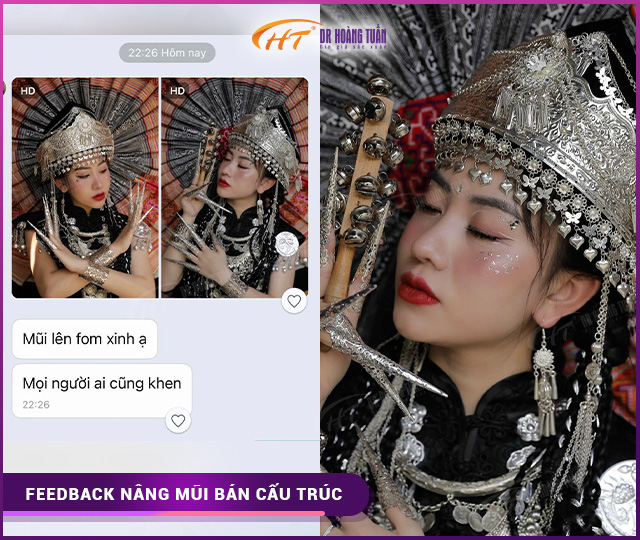 Feedback của khách hàng khi nâng mũi bán cấu trúc tại Dr Hoàng Tuấn