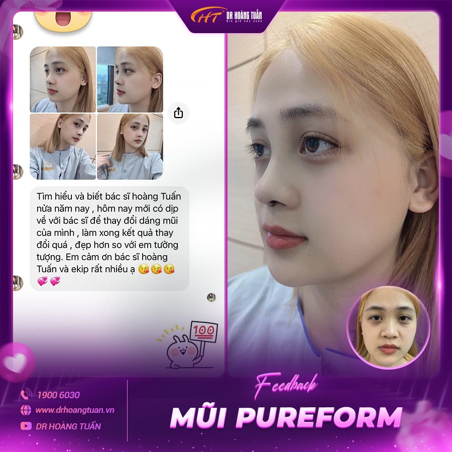 Feedback của khách hàng khi nâng mũi bán cấu trúc tại Dr Hoàng Tuấn
