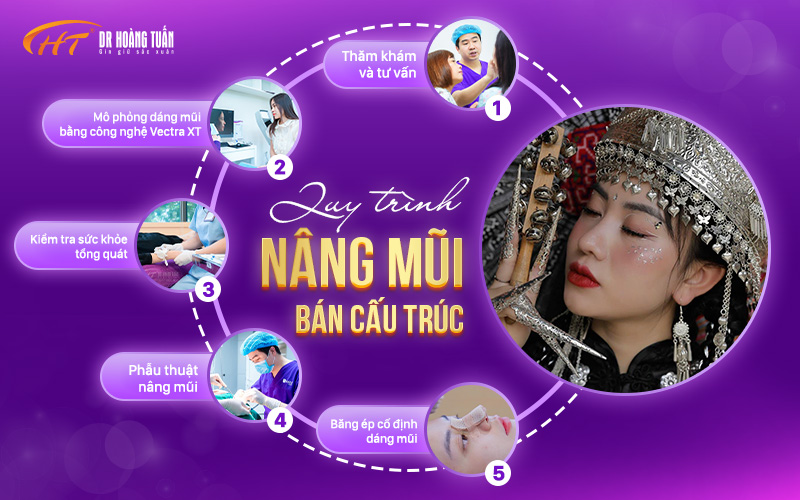 Quy trình nâng mũi bán cấu trúc 