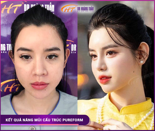Hình ảnh kết quả nâng mũi cấu trúc pureform tại Dr Hoàng Tuấn