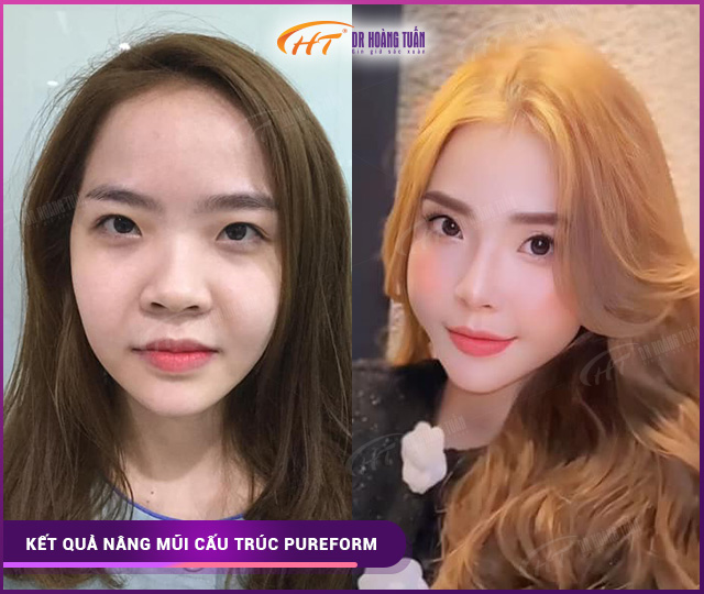 Hình ảnh kết quả nâng mũi cấu trúc pureform tại Dr Hoàng Tuấn